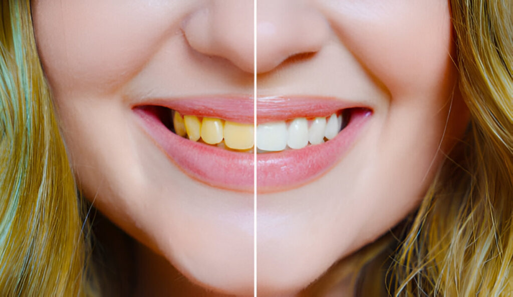 teeth whitening before and after