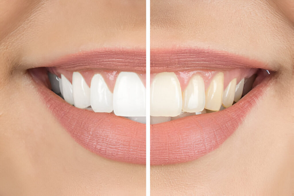 Teeth whitening Lahore