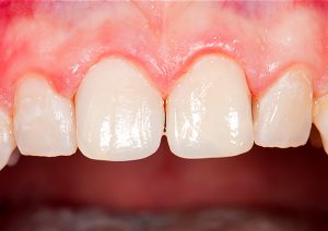 Teeth after whitening