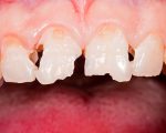 Teeth before whitening