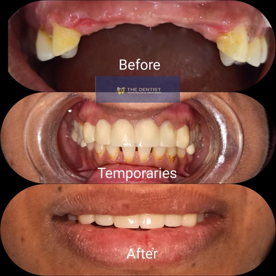 missing teeth fixed bridge temporaries