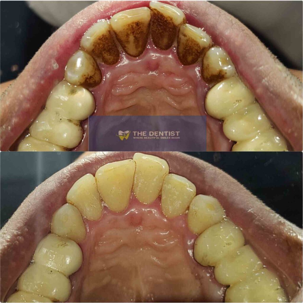 upper teeth scaling polishing