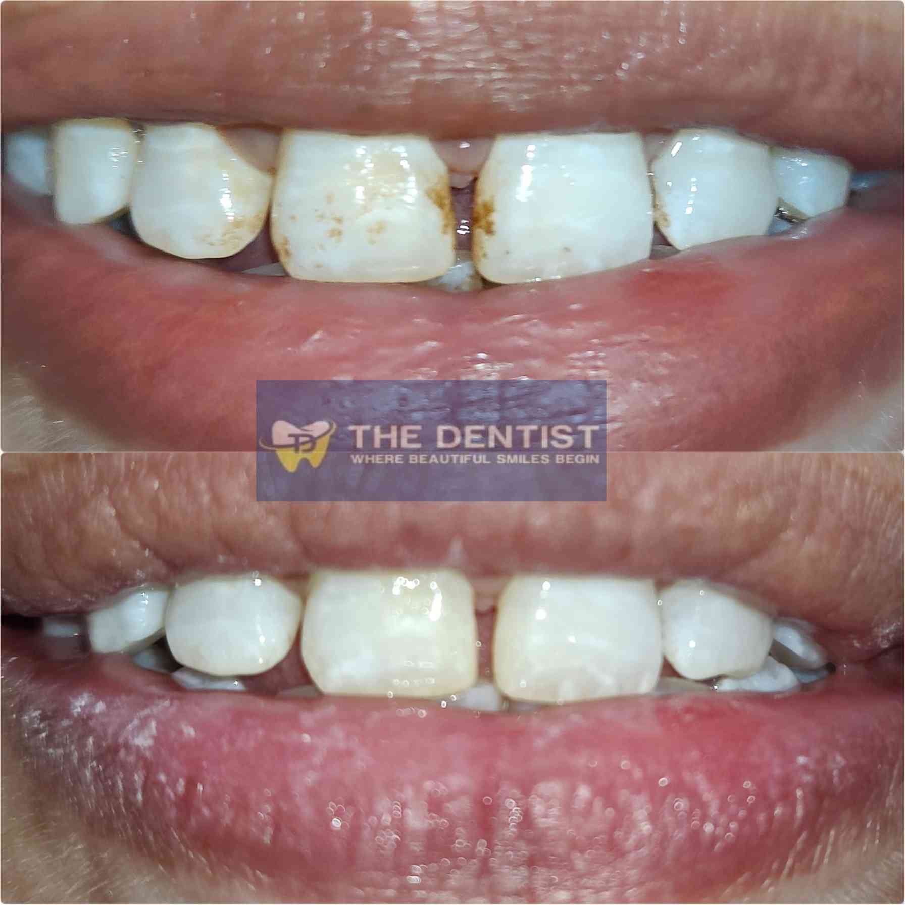 Front teeth stain removal before and after
