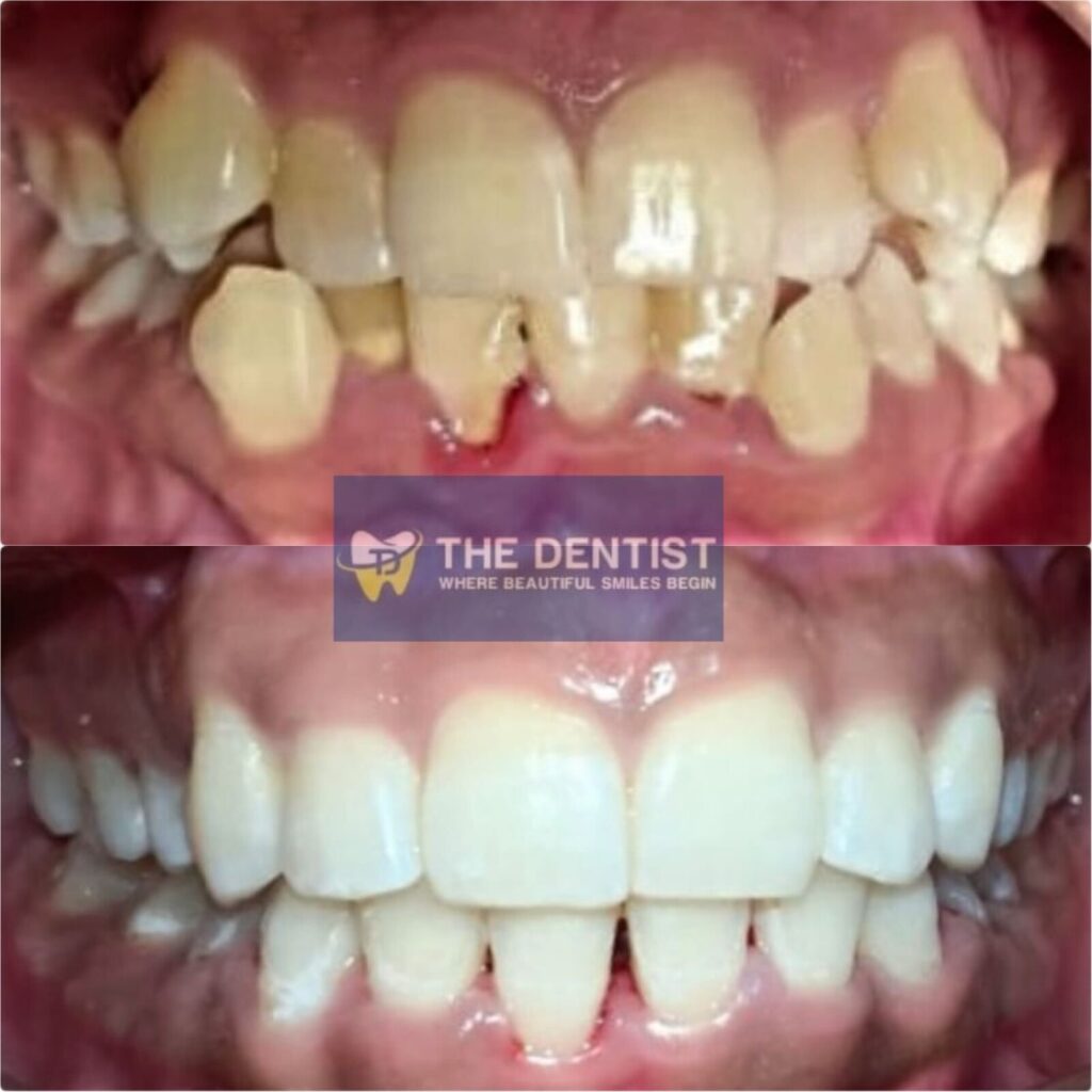 crooked teeth smile makeover