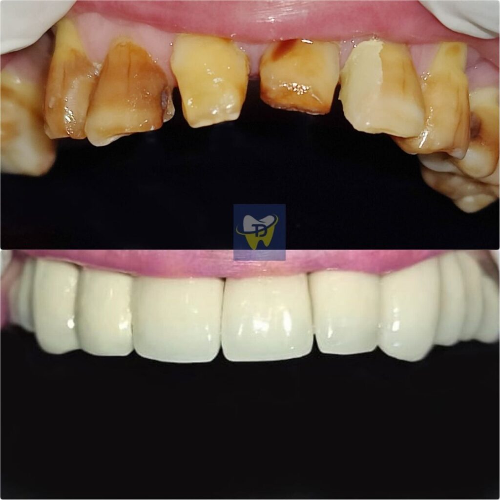 full mouth dental crowns smile makeover