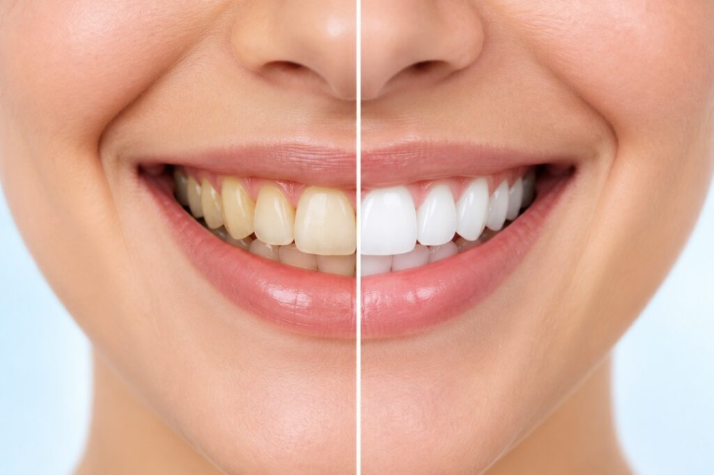 Teeth whitening treatment signs