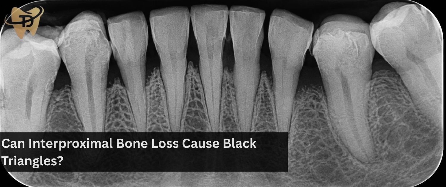 can interproximal bone loss cause black triangles