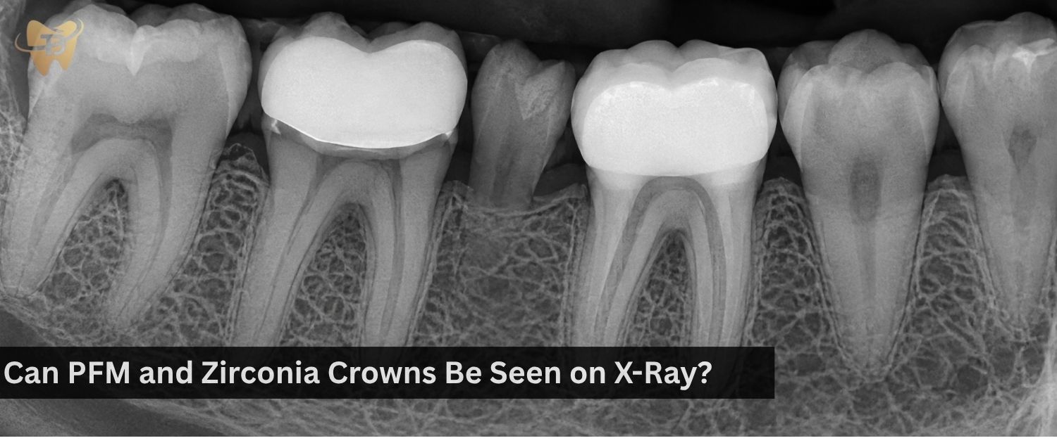 can pfm and zirconia crowns be seen on xray