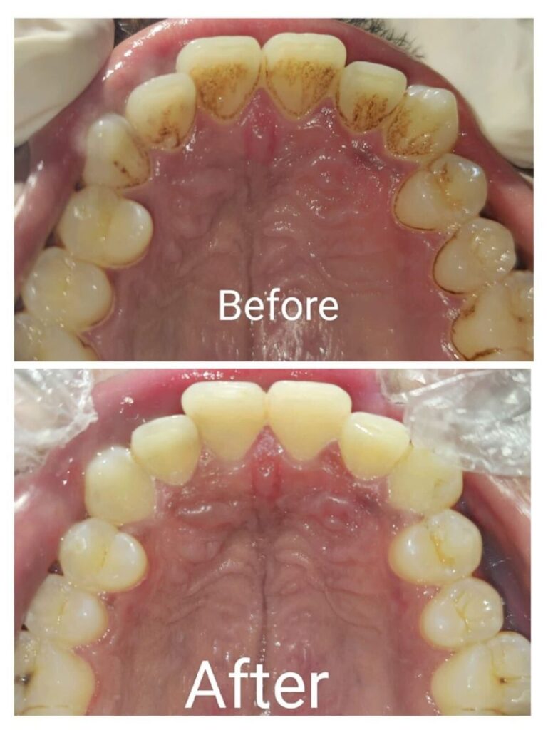 teeth scaling stain removal upper