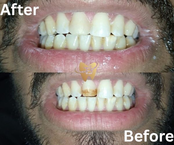 Teeth stain removal before and after