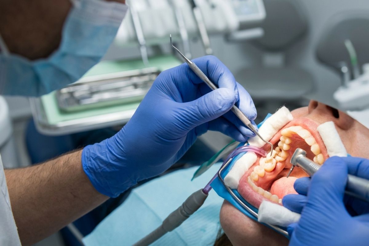 Dentist treating a patient's molar tooth with dental instruments during a cavity filling and tooth restoration procedure.