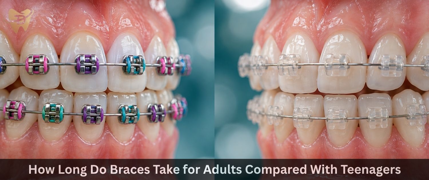 How Long Do Braces Take for Adults