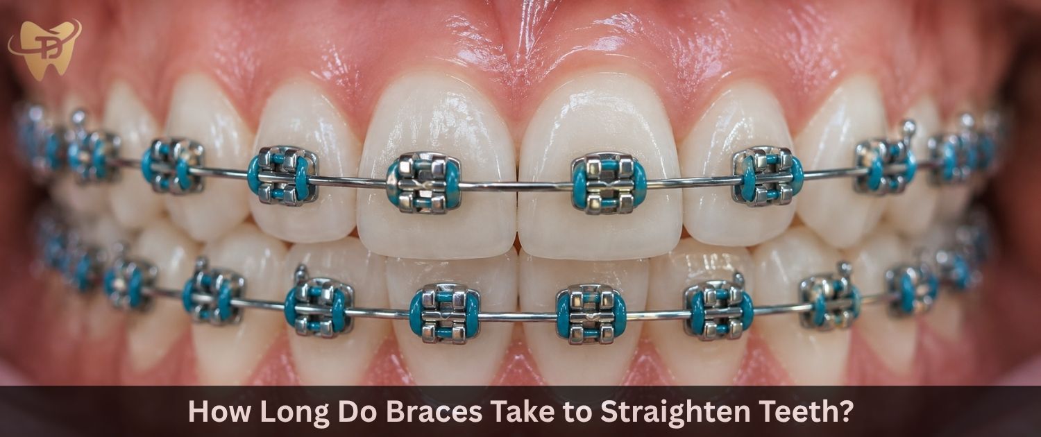 How Long Do Braces Take to Straighten Teeth