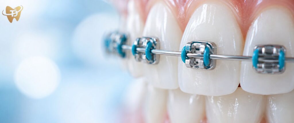 How Long Do Braces Take? Treatment Time in Lahore by Case Type