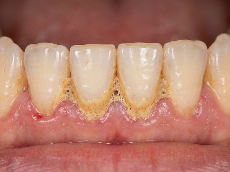 Yellow tartar buildup near the gumline