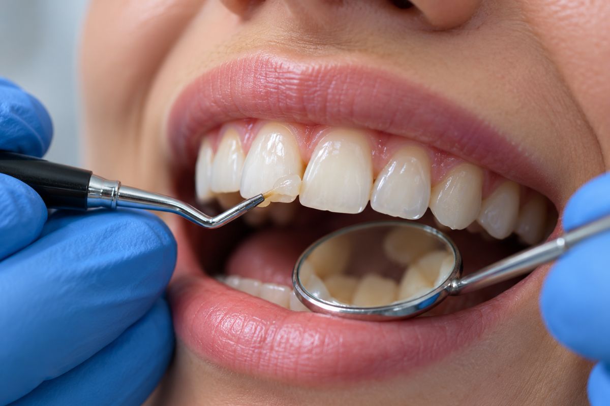 Close-up of dentist applying tooth-colored composite bonding material to a front tooth for cosmetic gap filling and smile restoration.