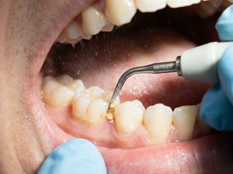 Macro macro photo of a dentist in DHA Lahore using an ultrasonic scaler tip with fine water spray to clean plaque and tartar from teeth along healthy pink gums.