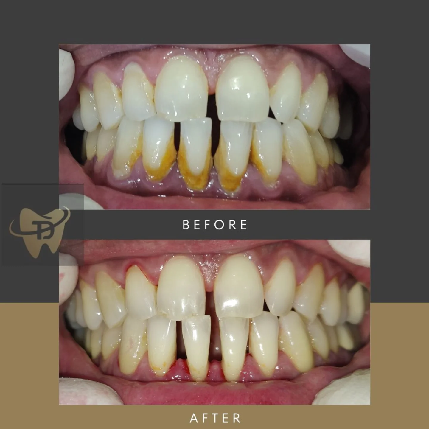 Yellow teeth stain removal before and after DHA Lahore